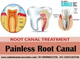 Can Painless Root Canal Treatment procedure be performed in India?