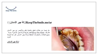 إزالة جير الأسنان | /KeepTheSmile.me/ar