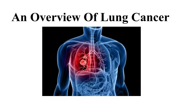 PPT - An Overview Of Lung Cancer PowerPoint Presentation, free download ...