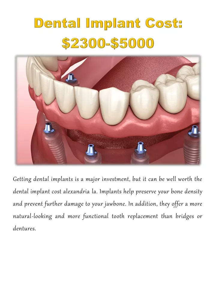 getting dental implants is a major investment