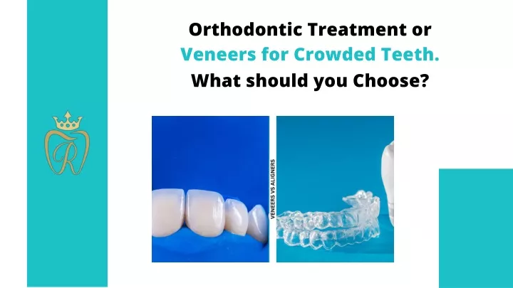 orthodontic treatment or veneers for crowded teeth