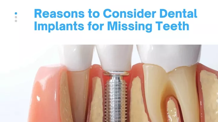 reasons to consider dental implants for missing