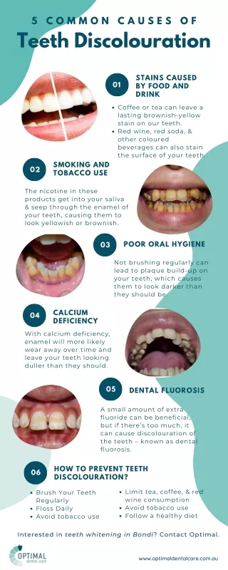 5 Common Causes of Teeth Discolouration