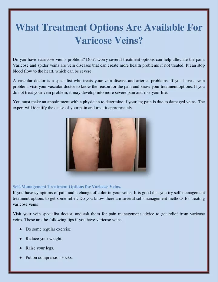 what treatment options are available for varicose