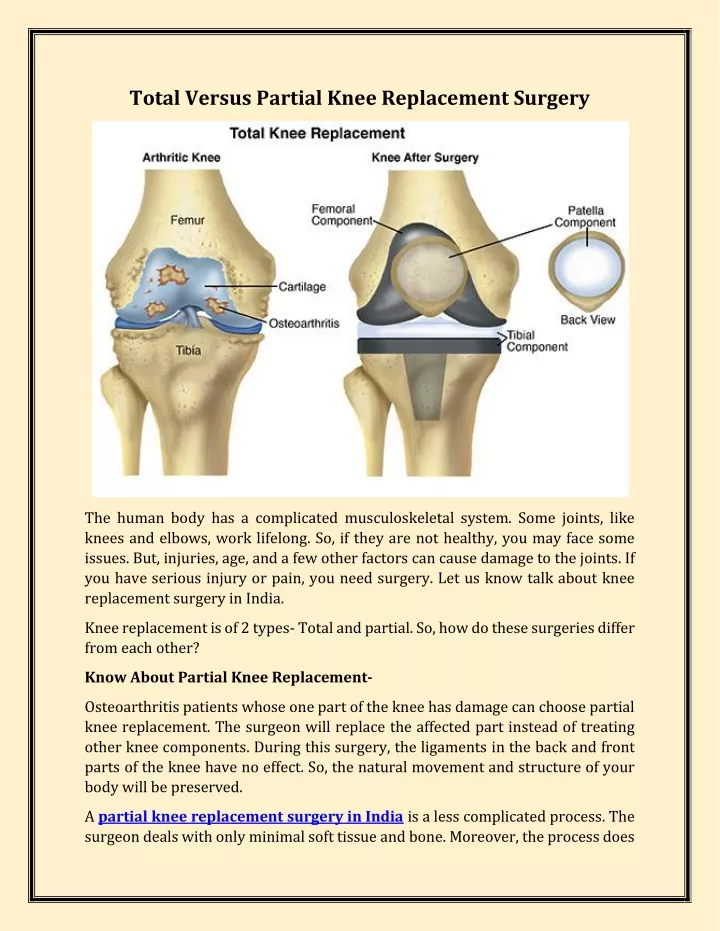 total versus partial knee replacement surgery