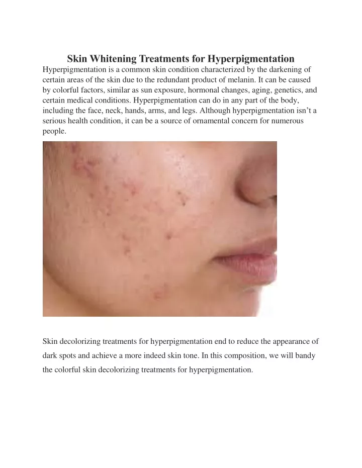 skin whitening treatments for hyperpigmentation