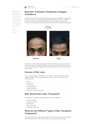 Best Hair Transplant Treatments to Regain Confidence