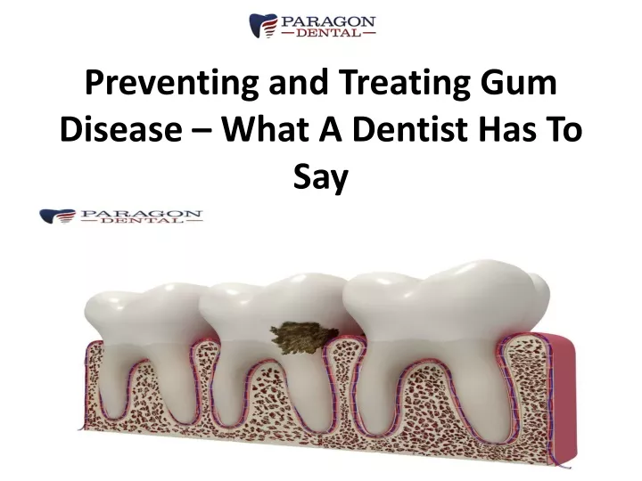 preventing and treating gum disease what a dentist has to say