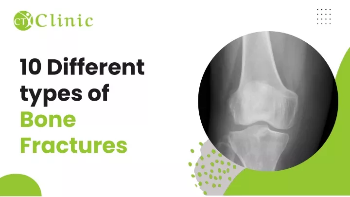 10 different types of bone fractures