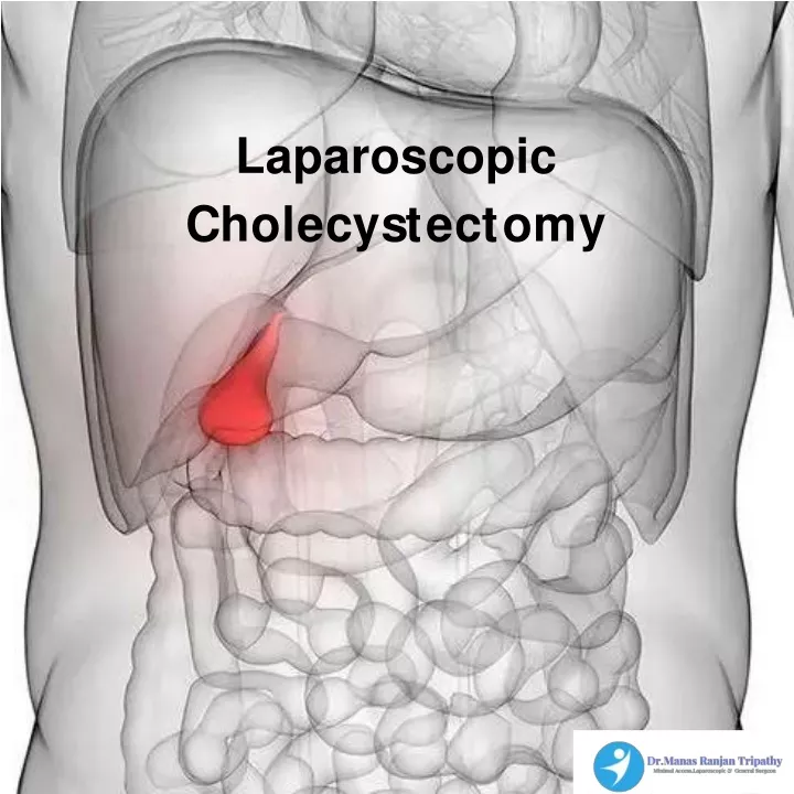 laparoscopic c h o l e c y s t e c t o m y