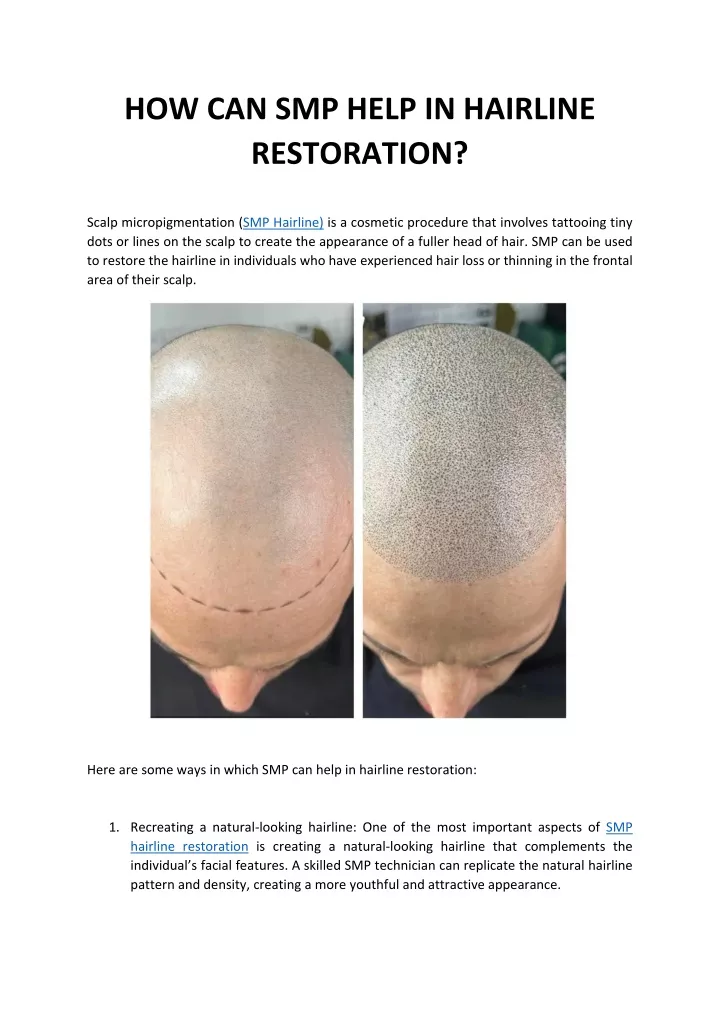 how can smp help in hairline restoration