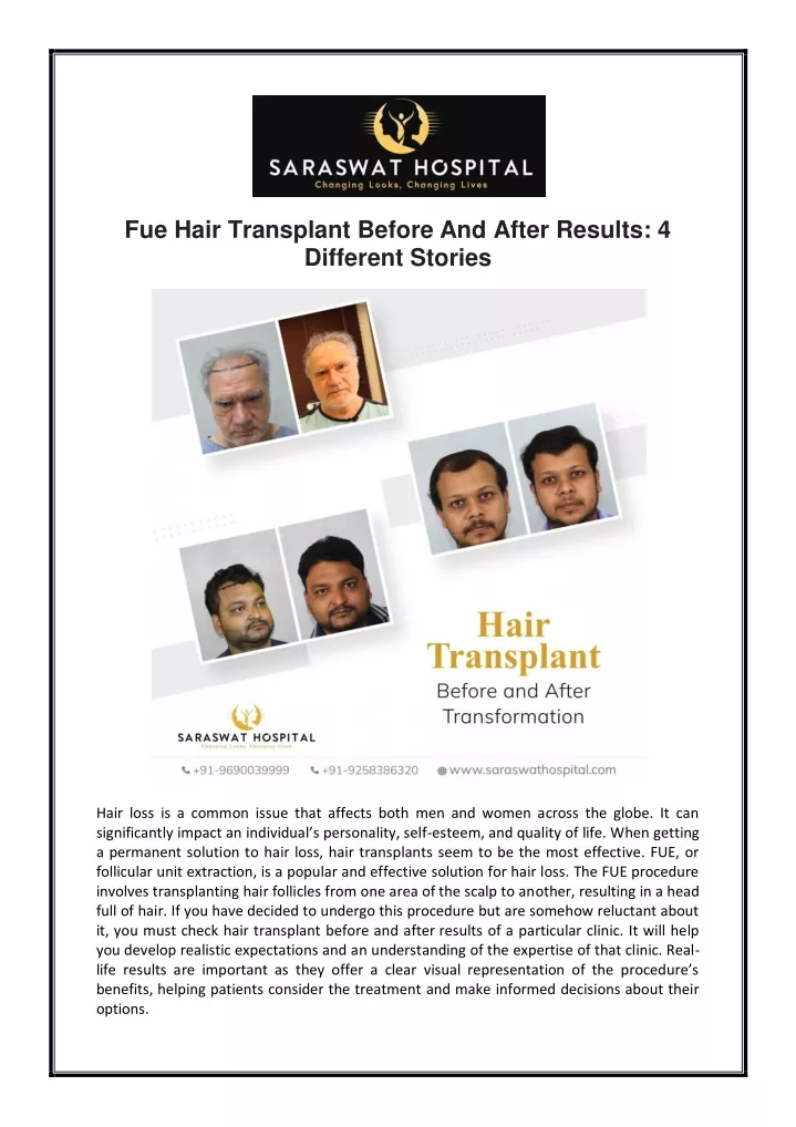 fue hair transplant before and after results