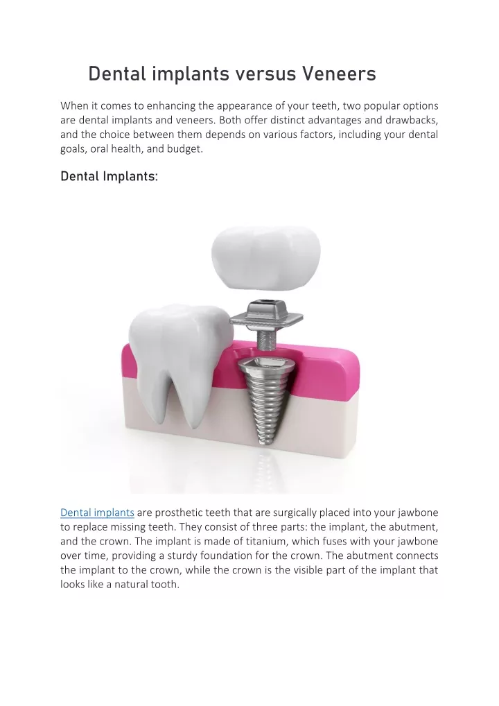 dental implants versus veneers