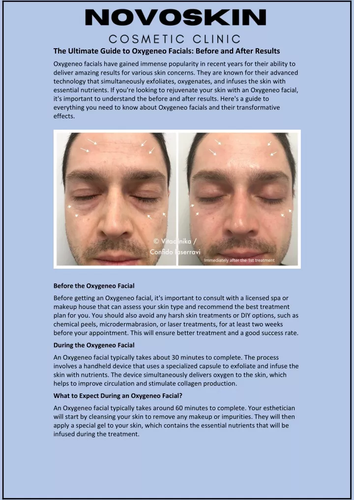 the ultimate guide to oxygeneo facials before