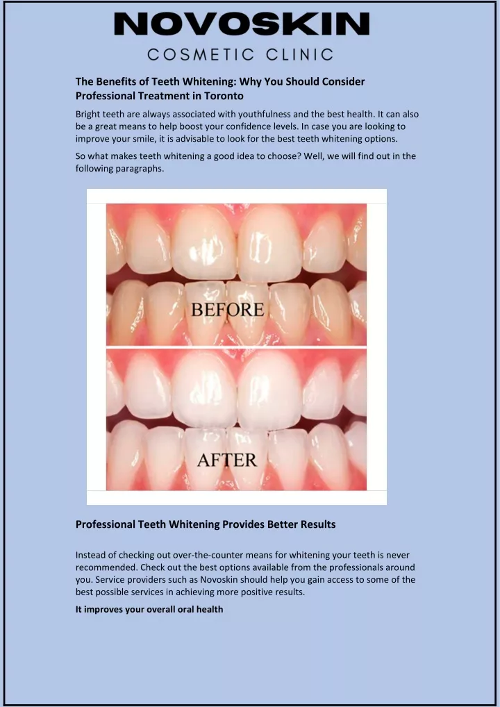 the benefits of teeth whitening why you should