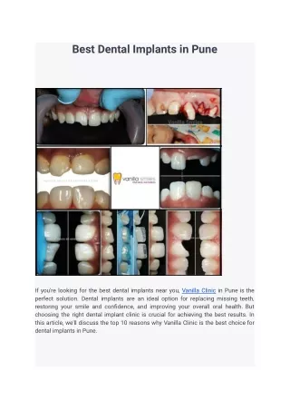 Best Dental Implants in Pune
