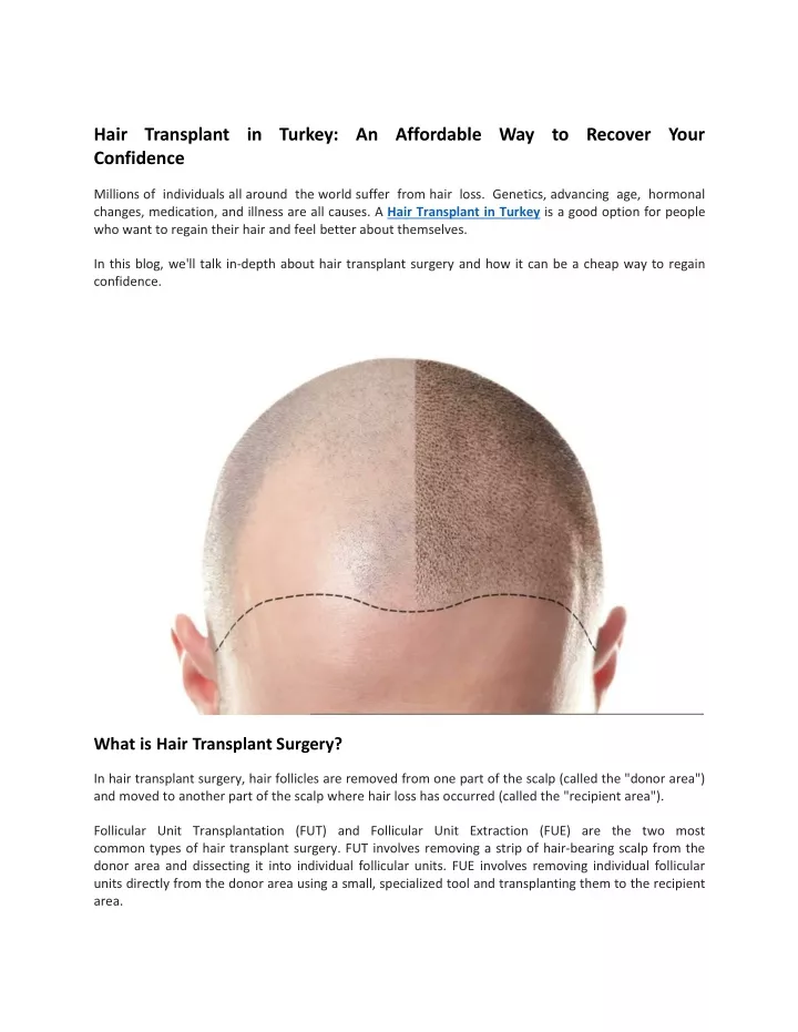 hair transplant in turkey an affordable