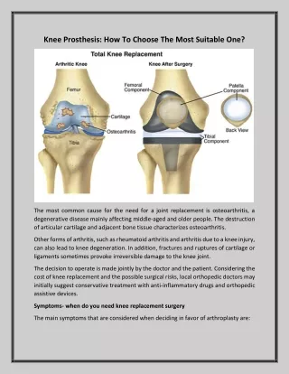 Knee Prosthesis: How To Choose The Most Suitable One?