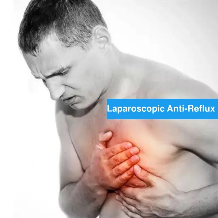laparoscopic anti reflux