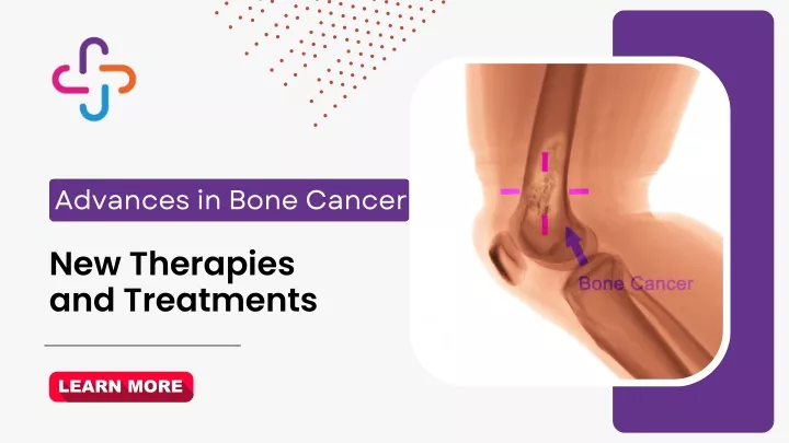 advances in bone cancer