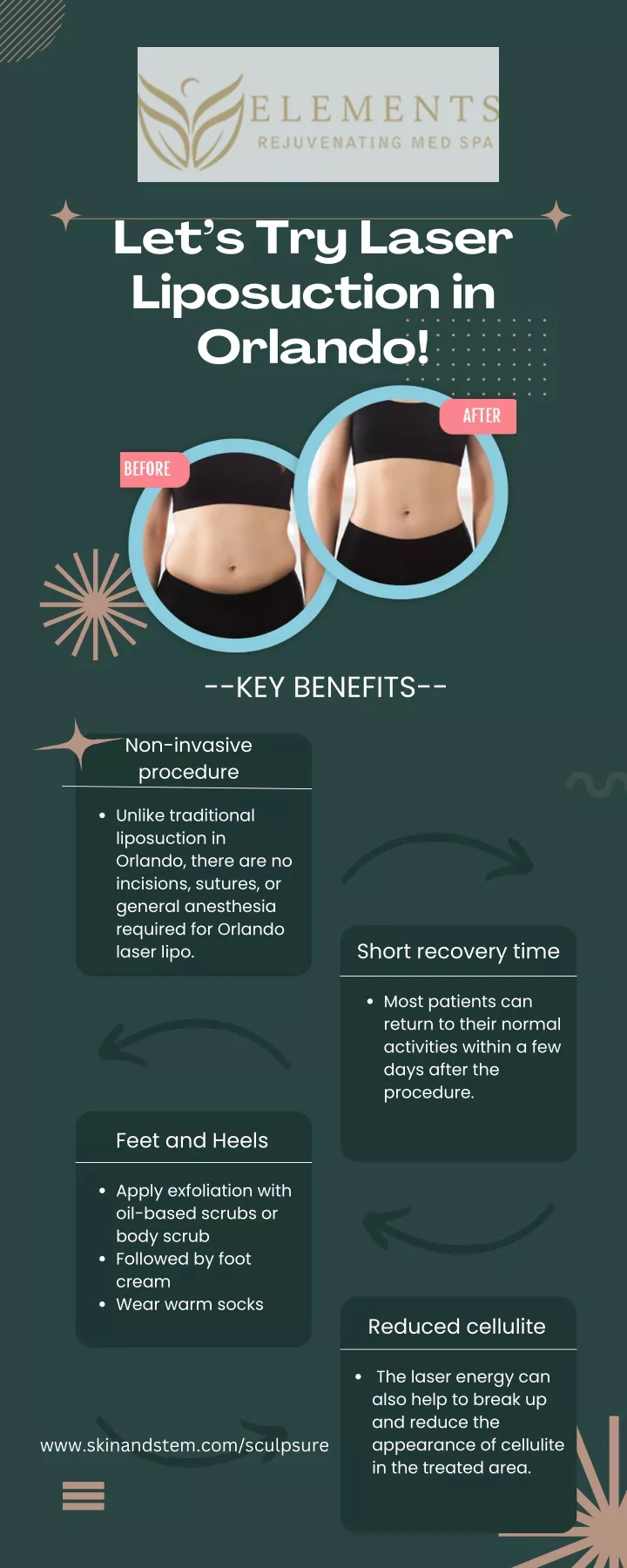 let s try laser liposuction in orlando