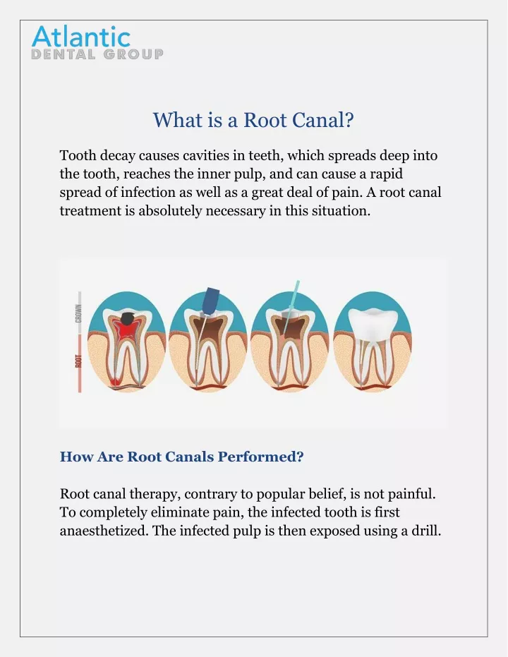 what is a root canal