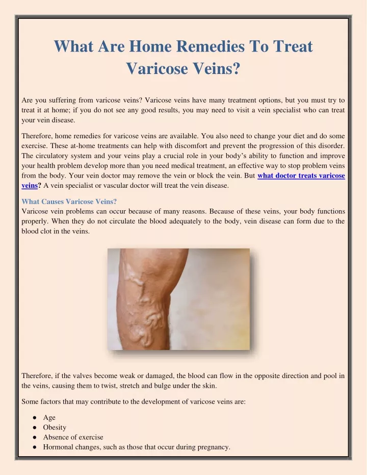 what are home remedies to treat varicose veins