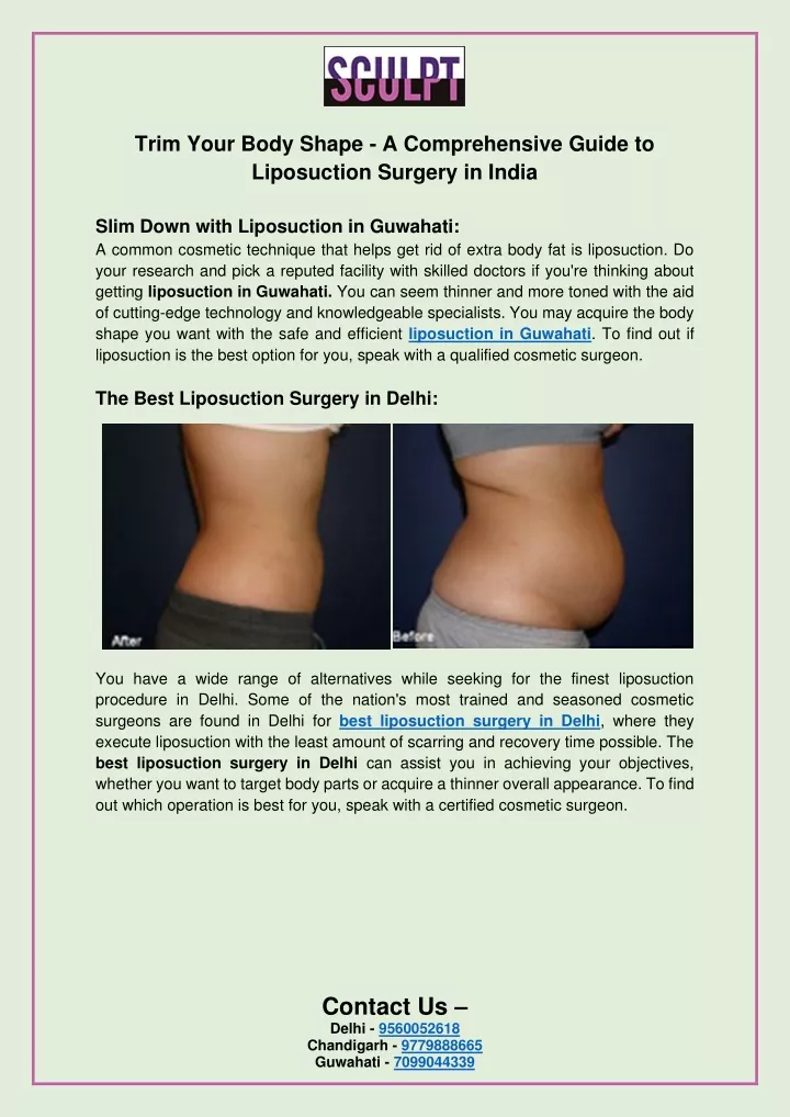 PPT Trim Your Body Shape A Comprehensive Guide To Liposuction Surgery In India PowerPoint