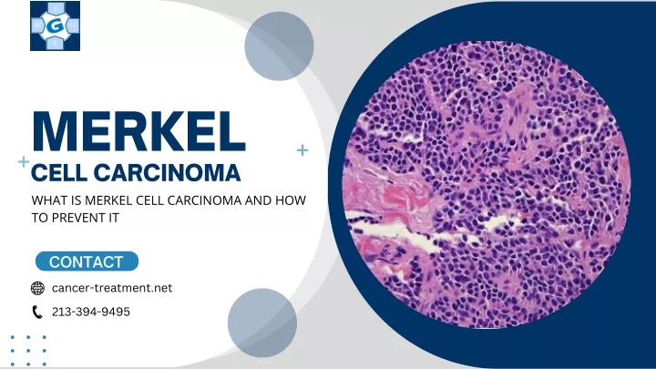 merkel cell carcinoma