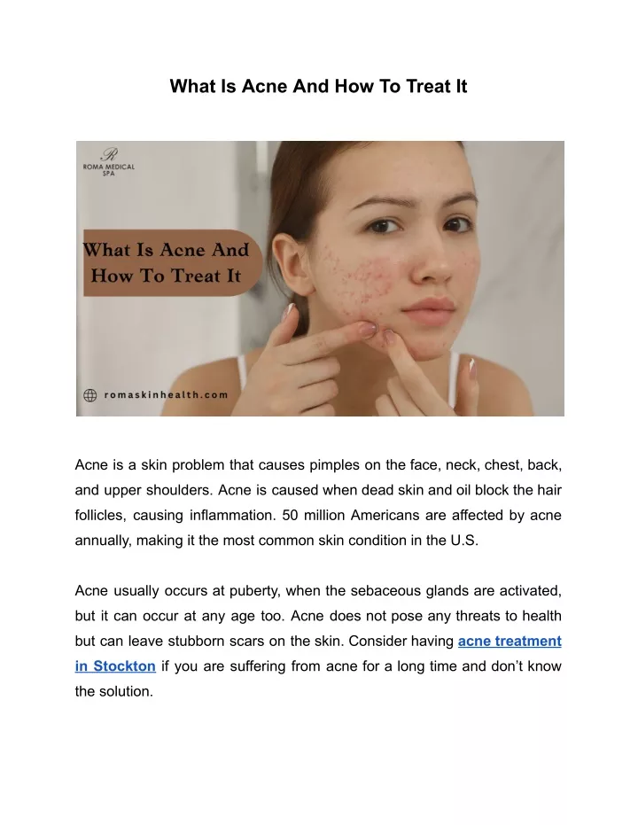 Ppt What Is Acne And How To Treat It Powerpoint Presentation Free Download Id12113953 