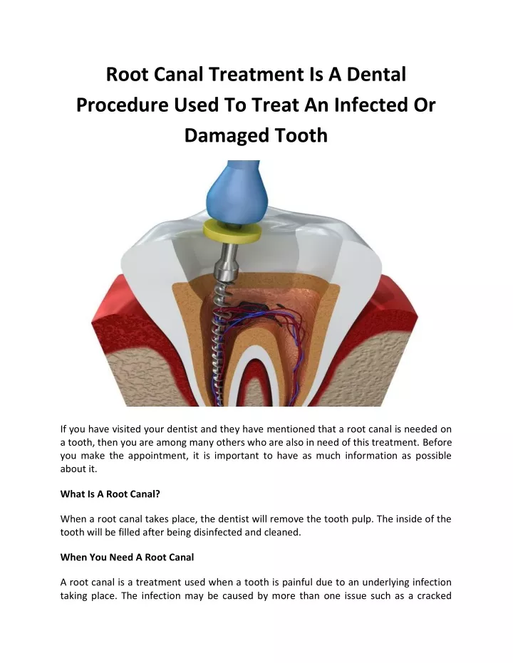 root canal treatment is a dental procedure used