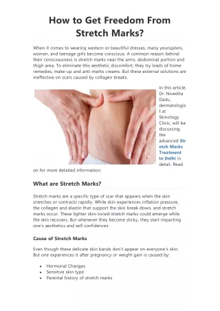 How to Get Freedom From Stretch Marks?