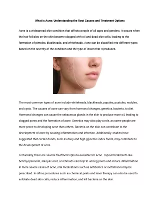 What is Acne_ Understanding the Root Causes and Treatment Options