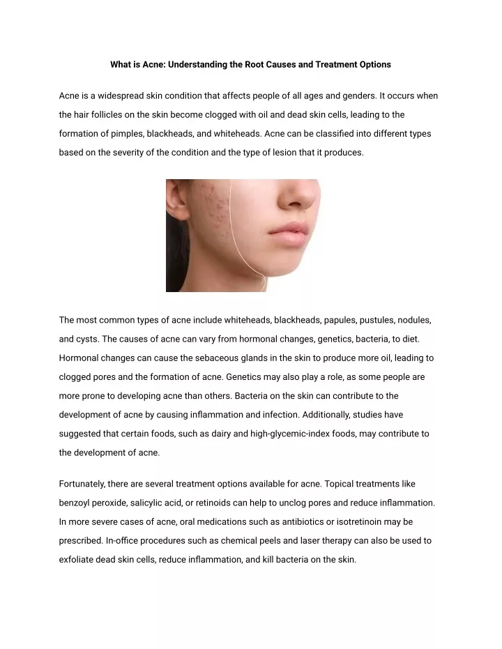 what is acne understanding the root causes