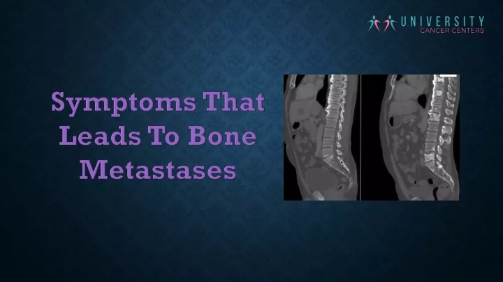 symptoms that leads to bone metastases