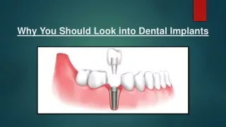 Why You Should Look into Dental Implants