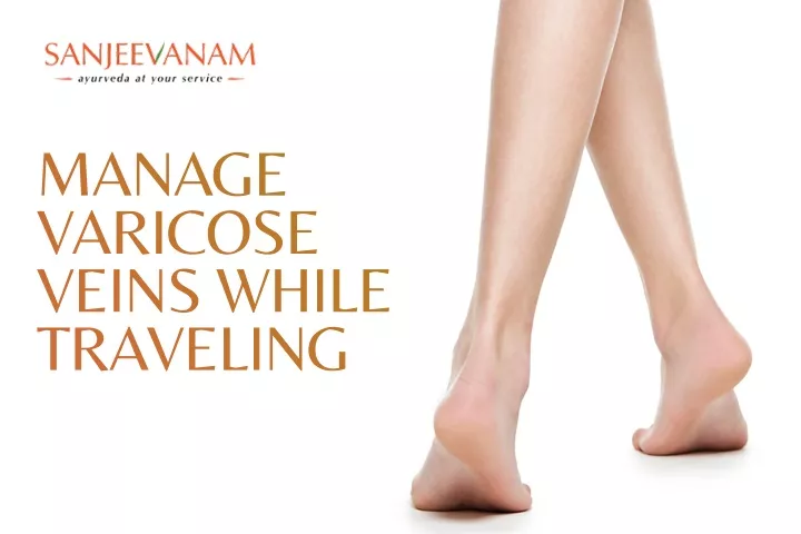 manage varicose veins while traveling